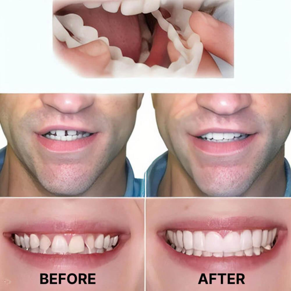 Clip-On Dental Veneers zaxx